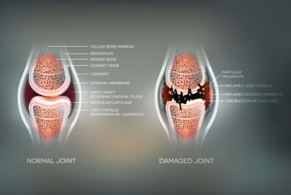 Knee Diagram - Normal Knee vs. Damaged Knee
