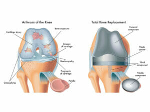Total Knee Replacement Surgery Diagram Comparison 